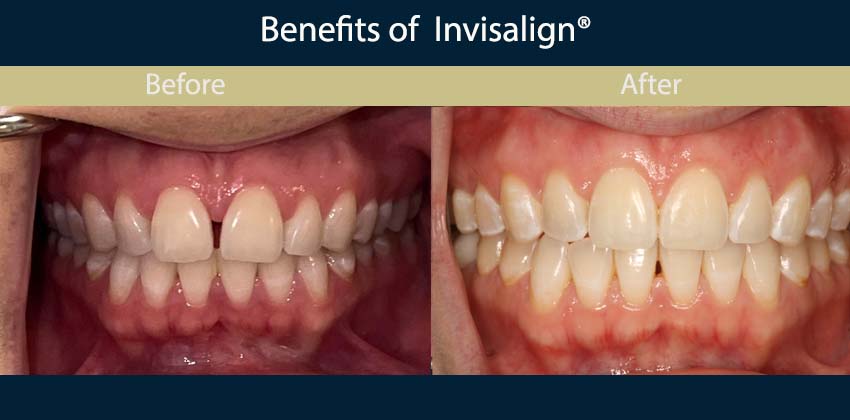 invisalign-dentist-upper-east-side